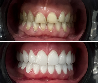 zirconium crowns