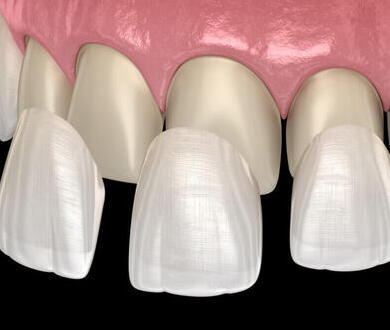 Single arch veneers package - Giza