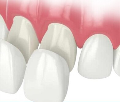 Veneer Smile Design Package