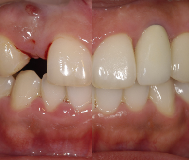 Dental implant before and after