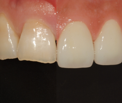 Dental veneers before and after