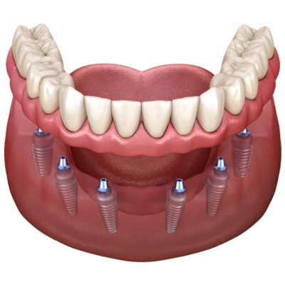 all on 6 dental implants