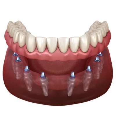 All-on-8 dental implants